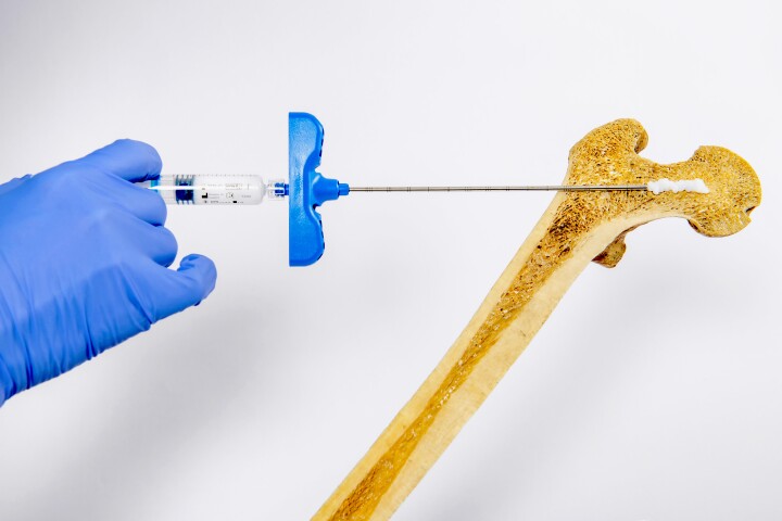 When injected into a weakened bone, the hydrogel boosts bone density by prompting the growth of new bone tissue