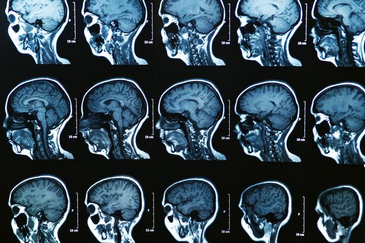 AI analysis of MRI brain scans have identified three new subtypes of multiple sclerosis