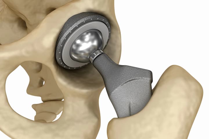 Commonly used Ti-6Al-4V titanium is much stiffer than bone (which isn't a good thing), and has little effect on harmful bacteria